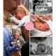 Hanna prematuur geboren met 30 weken en 4 dagen, HELLP syndroom hoge bloeddruk